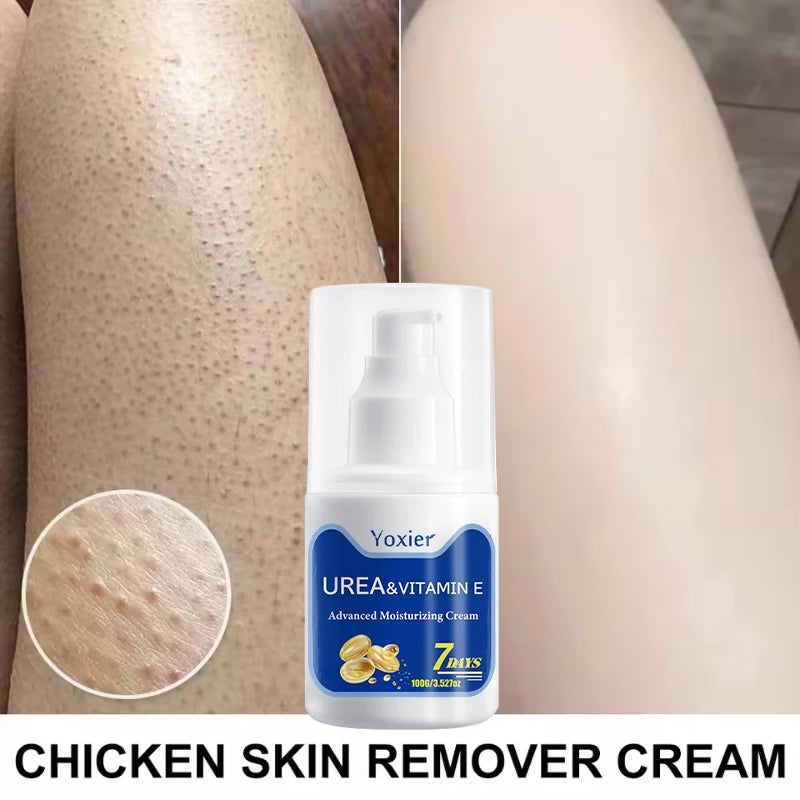 100g Chicken Skin Removal Cream Body Repair Keratosis Pilaris Rough Bumpy Pore Spots Dull Skin Care Whitening Moisturizing